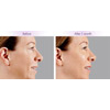 dermal fillers, juvederm voluma xc example 1, your results may vary